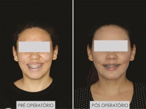 PRE E POS OPERATORIO